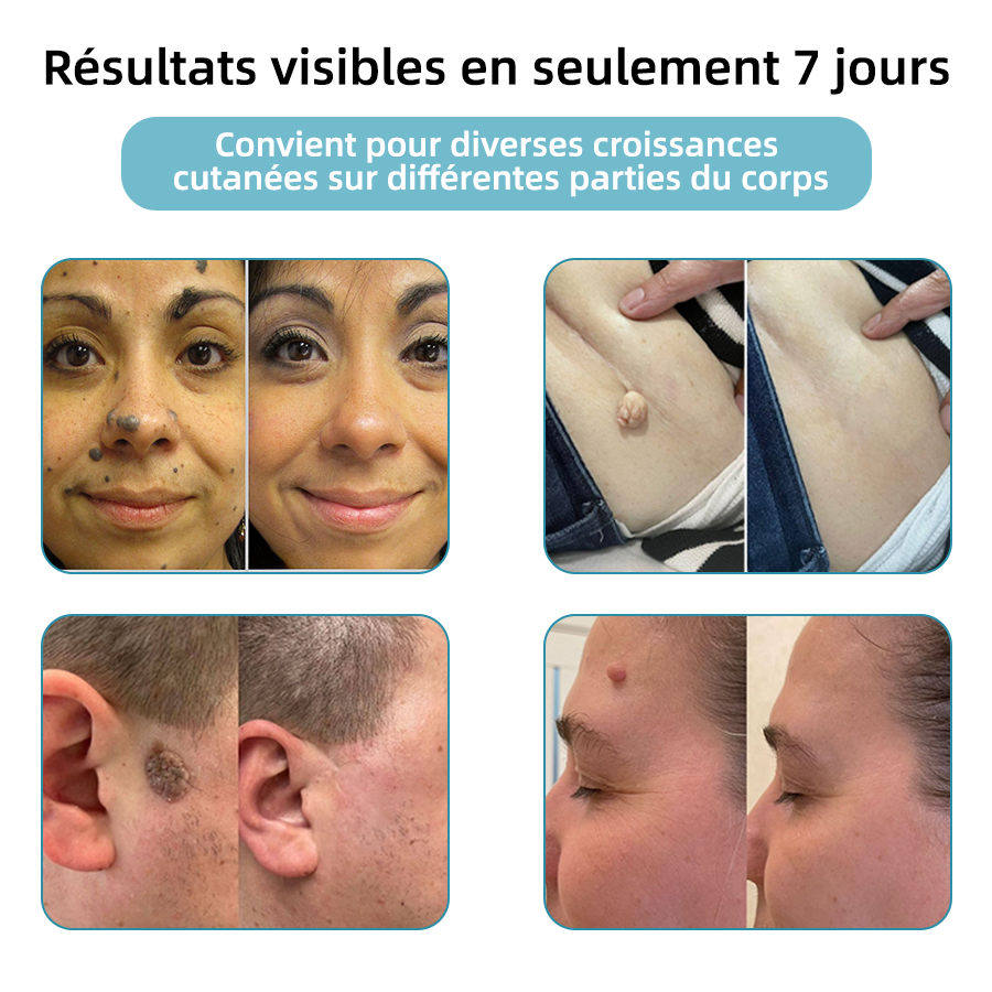 kidsneed® Stilou laser neinvaziv pentru îndepărtarea coșurilor de frumusețe și a negilor ✨✨✨