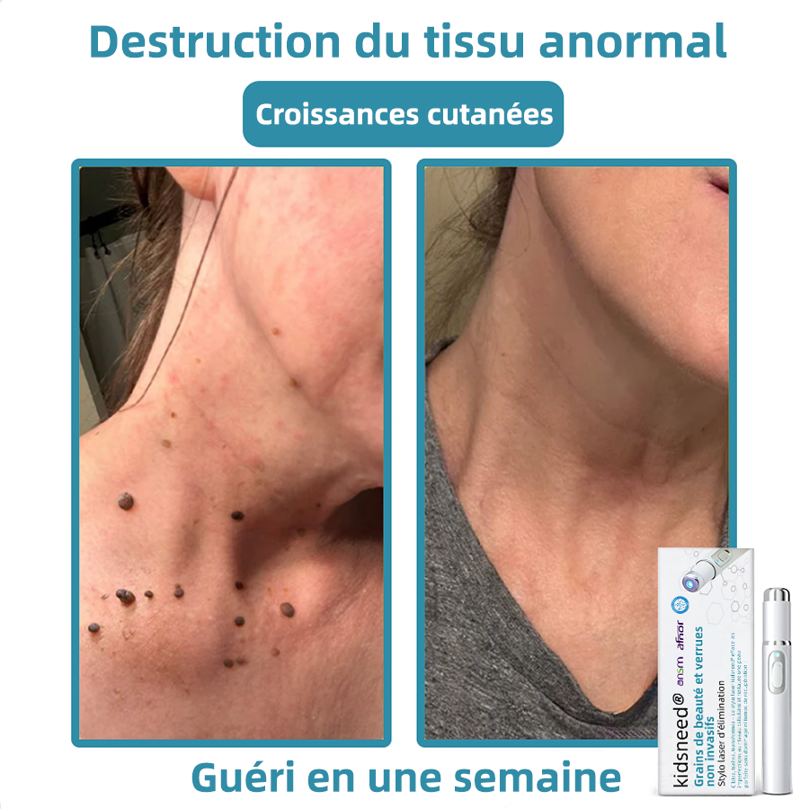 kidsneed® Stilou laser neinvaziv pentru îndepărtarea coșurilor de frumusețe și a negilor ✨✨✨