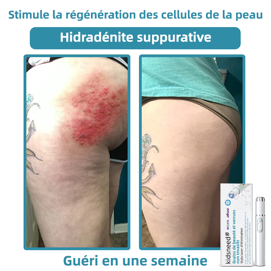kidsneed® Stilou laser neinvaziv pentru îndepărtarea coșurilor de frumusețe și a negilor ✨✨✨