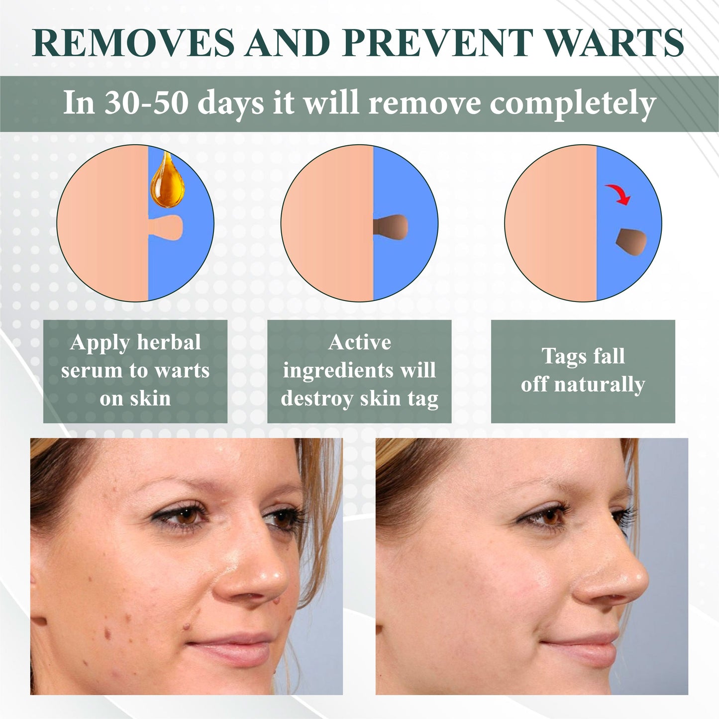 DermaEase™ Natureerase Gel de îndepărtare instantanee a petelor de aluniță