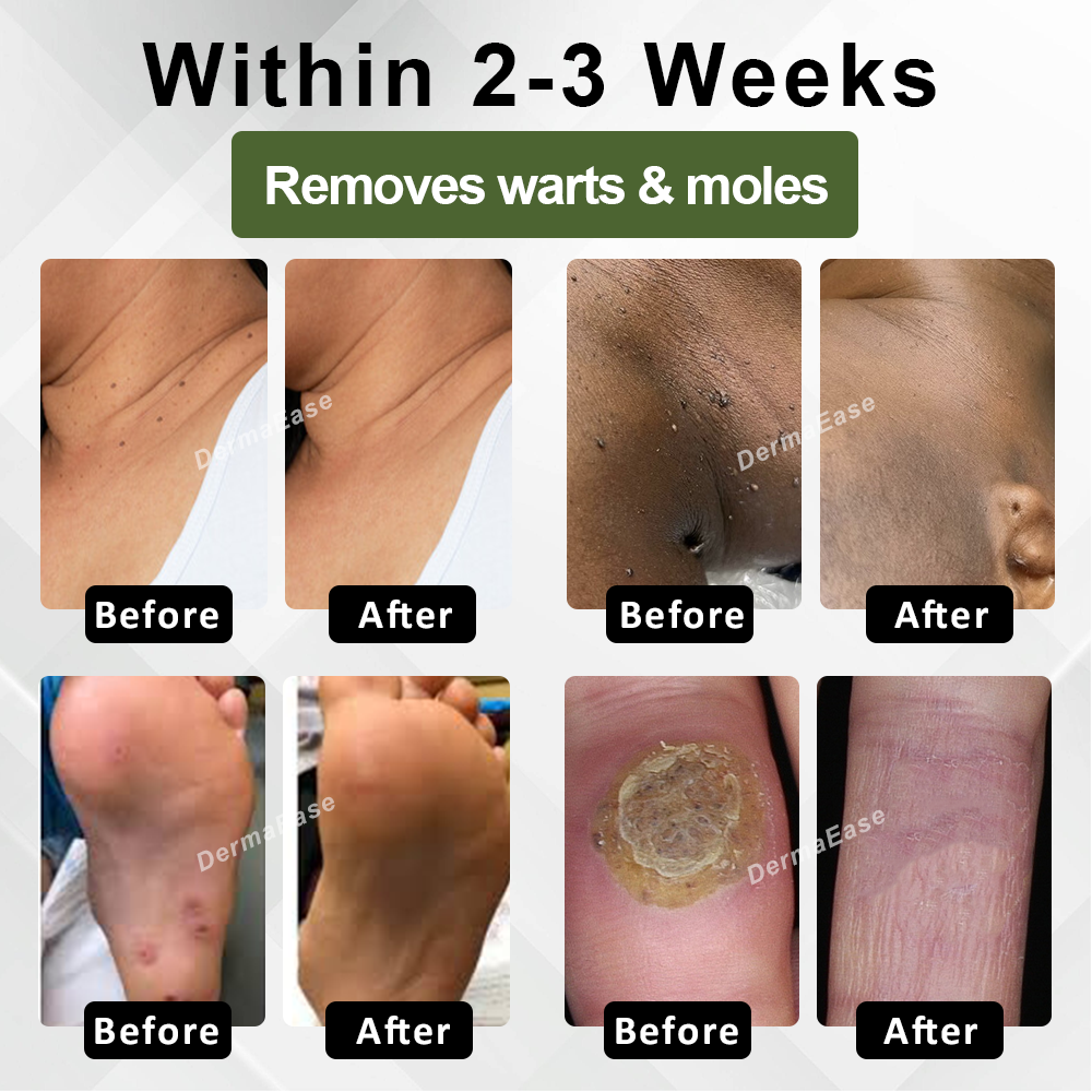 DermaEase™ Natureerase Gel de îndepărtare instantanee a petelor de aluniță