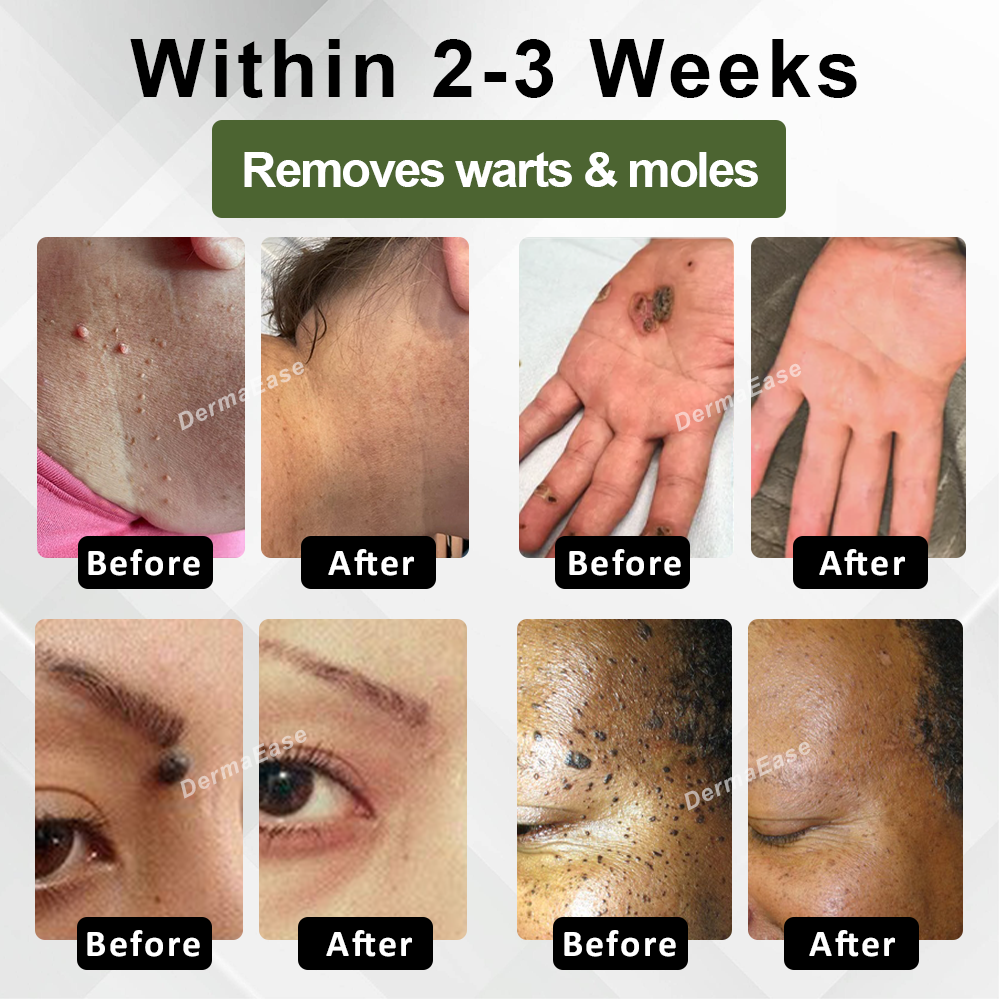 DermaEase™ Natureerase Gel de îndepărtare instantanee a petelor de aluniță