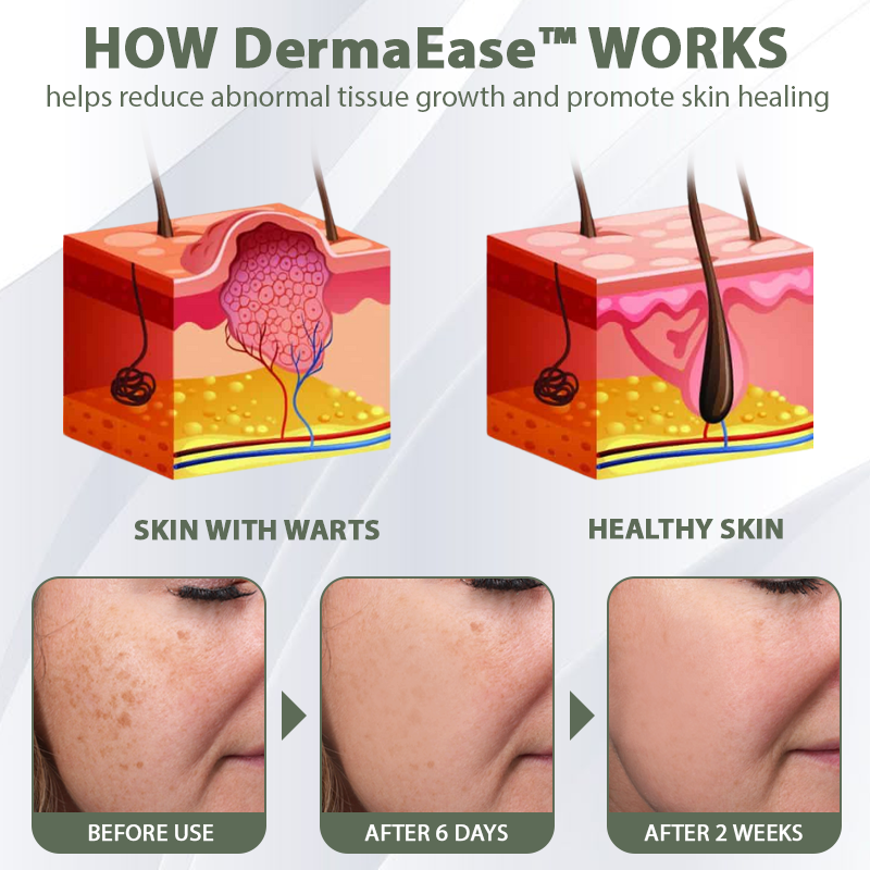 DermaEase™ Natureerase Gel de îndepărtare instantanee a petelor de aluniță