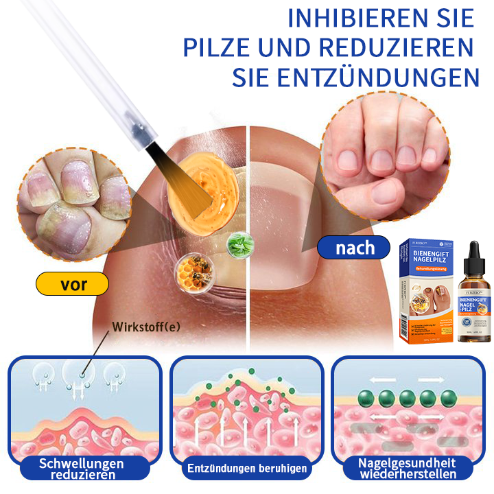 🐝🐝Furzero™ venin de albine ciuperca unghiilor soluție de tratament: rezolva complet problema ciupercii unghiilor🌟👣