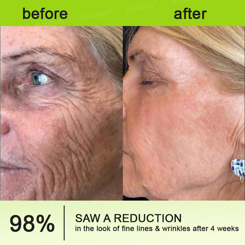 💛✅Az USA-ban gyártva és onnan szállítva 💫Rolimey® Botox & Vita-A Retinol Shot ránctalanító és feszesítő krém – Utolsó napos akció 70% kedvezmény