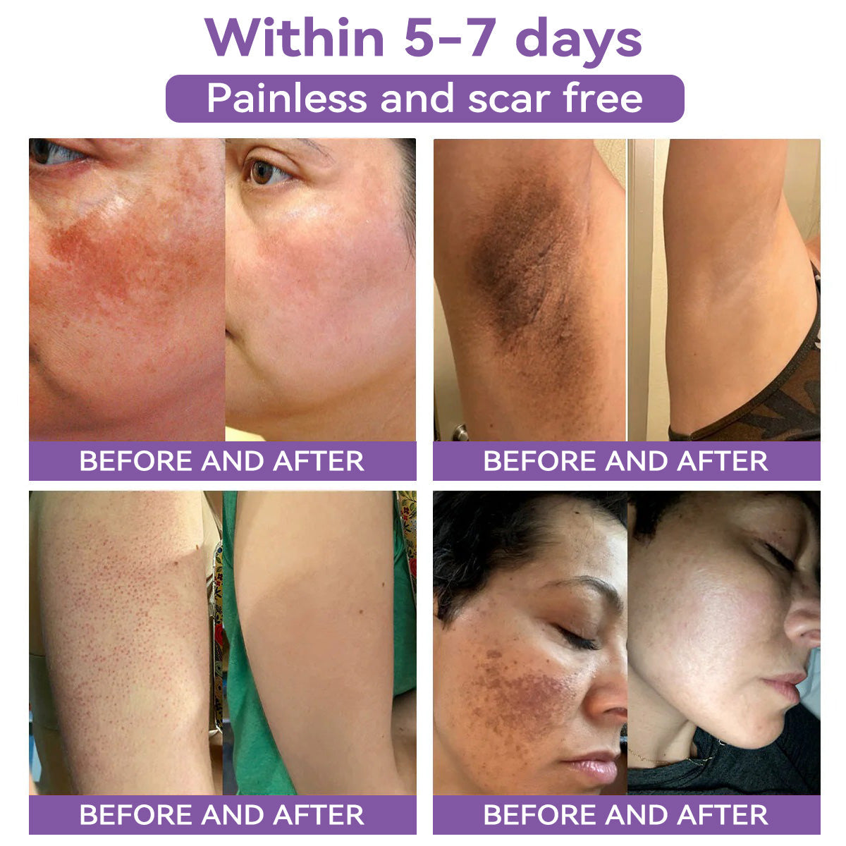 Totai Skin Confidence Începe Aici ✅ Bostore® Acid Hialuronic Nano Microneedle Repair Tape ✴️ Pentru diverse cicatrici, vergeturi, pete, keloide, keratoze, acnee, arsuri, negi, etichete de piele și vene varicoase.
