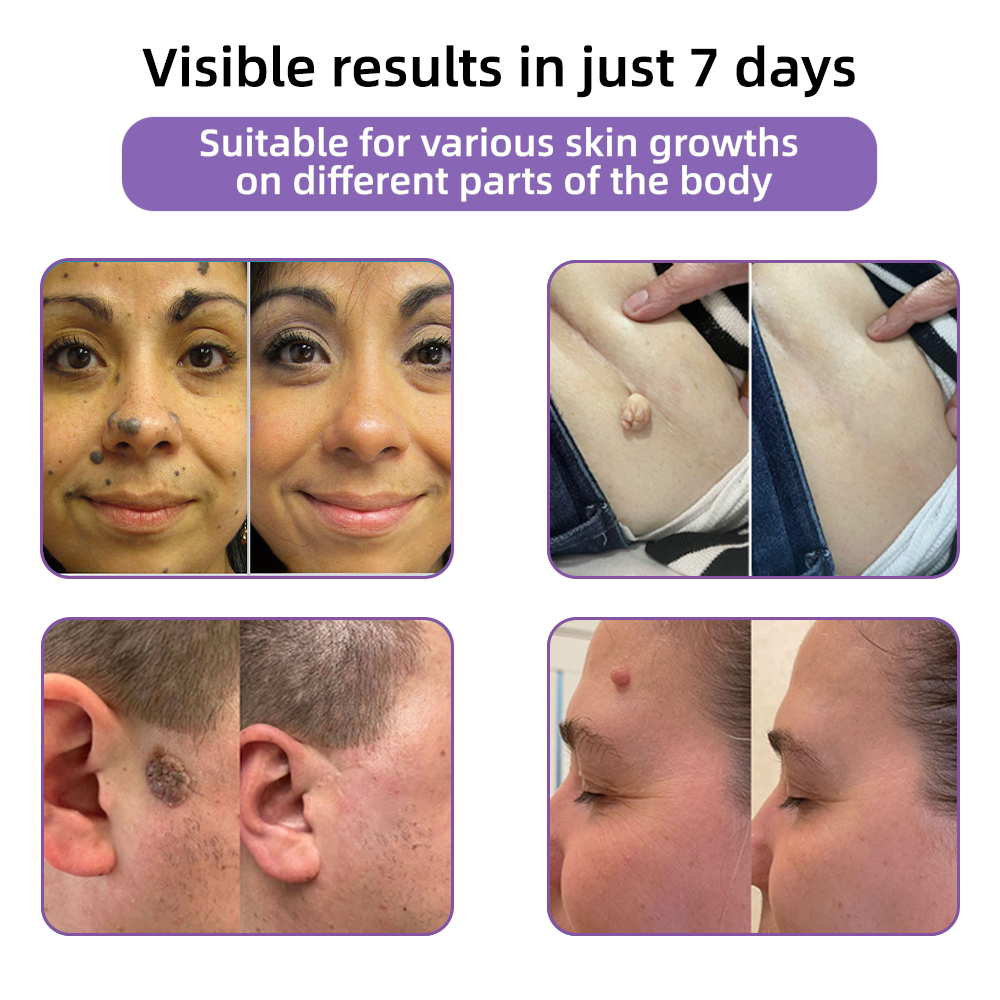 Totai Skin Confidence Începe Aici ✅ Bostore® Acid Hialuronic Nano Microneedle Repair Tape ✴️ Pentru diverse cicatrici, vergeturi, pete, keloide, keratoze, acnee, arsuri, negi, etichete de piele și vene varicoase.