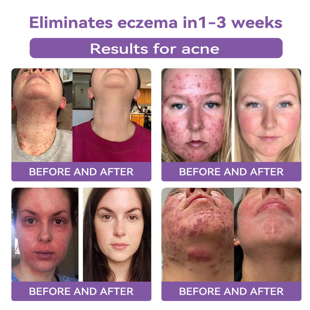 Totai Skin Confidence Începe Aici ✅ Bostore® Acid Hialuronic Nano Microneedle Repair Tape ✴️ Pentru diverse cicatrici, vergeturi, pete, keloide, keratoze, acnee, arsuri, negi, etichete de piele și vene varicoase.