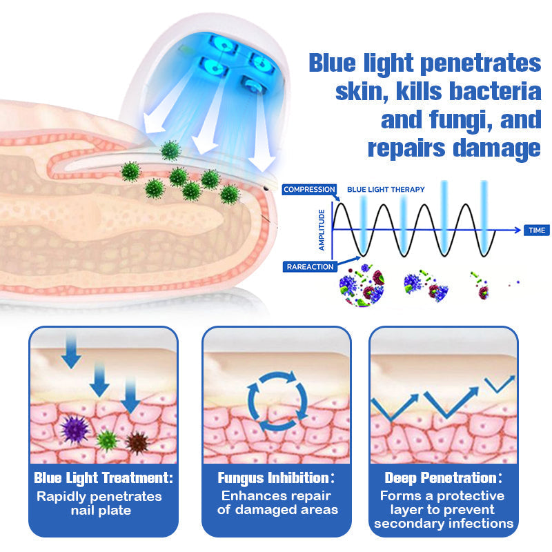 (⭐LIMITED DISCOUNT 70% - UTOLSÓ NAP⭐)Furzero ™ Lézeres körömgomba eltávolító készülék🔥
