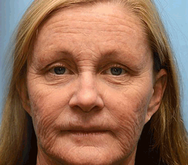 💛✅Az USA-ban gyártva és onnan szállítva 💫Rolimey® Botox & Vita-A Retinol Shot ránctalanító és feszesítő krém – Utolsó napos akció 70% kedvezmény